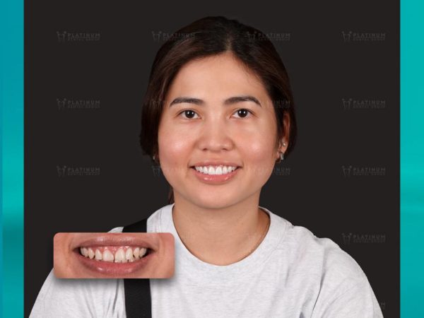 Dán sứ veneer có thể khắc phục tình trạng răng bị nhiễm Tetracycline nhẹ