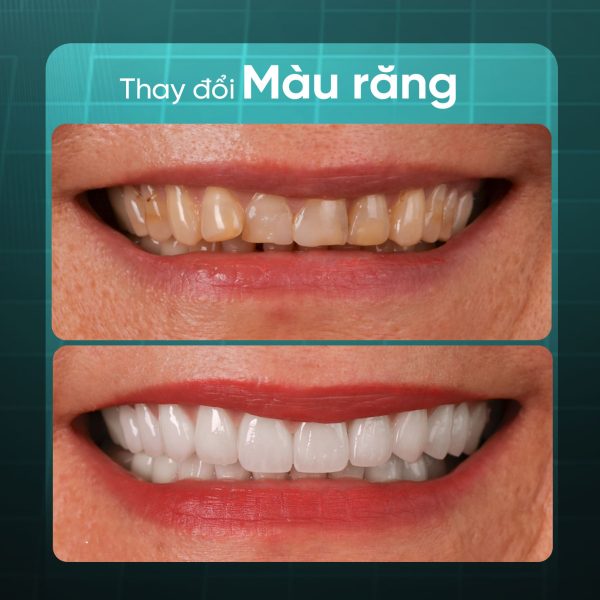 Có thể lựa chọn phương pháp bọc sứ để cải thiện màu sắc, phục hồi hình thể và chức năng ăn nhai