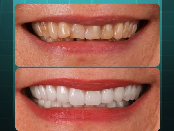 Có thể lựa chọn phương pháp bọc sứ để cải thiện màu sắc, phục hồi hình thể và chức năng ăn nhai