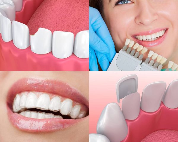 Is a Smile Makeover Right For You? Costs, Benefits, and Procedures 2 Smile makeover treatments address tooth color, alignment, missing teeth, and overall balance for a natural, radiant smile