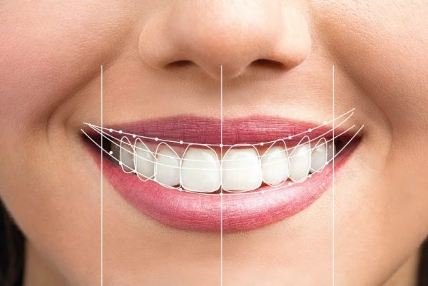 Is a Smile Makeover Right For You? Costs, Benefits, and Procedures 1 What's Included in a Smile Makeover?