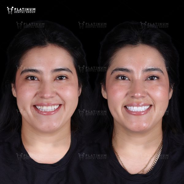 Ms. Daily (Mexico) hài lòng với nụ cười mới hoàn hảo hơn sau dán sứ Veneer.