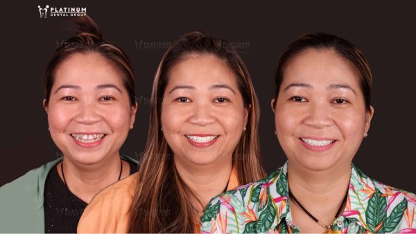 Ms. Lyna (Việt Nam) từng bị nhiễm màu nặng, các răng có hình dáng không đồng đều. Sau 2 năm mão sứ tại Platinum Dental Group, chị vẫn rất hài lòng với nụ cười răng sứ tự nhiên, hợp với gương mặt của chị.