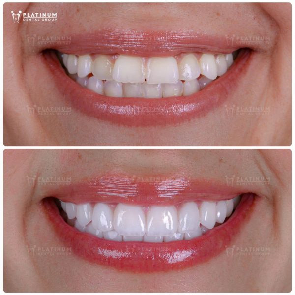 Trước và sau khi dán sứ Veneer.