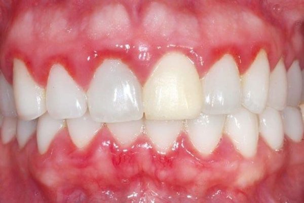 Swollen gums – causes, treatments, and expert care at Platinum Dental Group 1 Simple definition of swollen gums