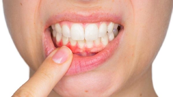 Swollen gums – causes, treatments, and expert care at Platinum Dental Group 2 Main causes of swollen gums