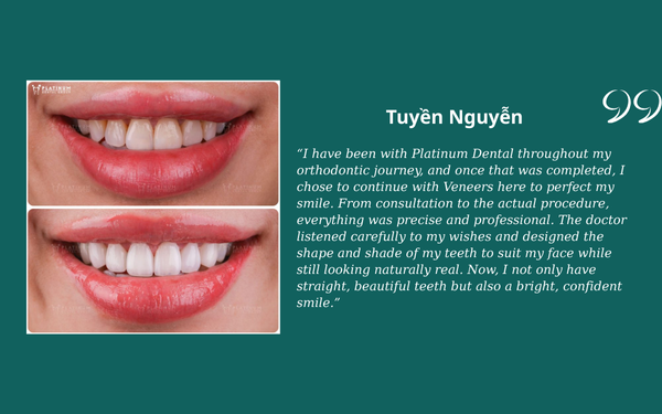 What Do Clients Say About Platinum Dental? Tuyền Nguyễn