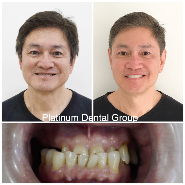 Your dentist will recommend treatment based on the cause and severity of tooth wear