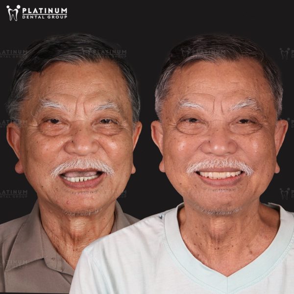 The loss of vertical dimension can cause the face to appear “collapsed”