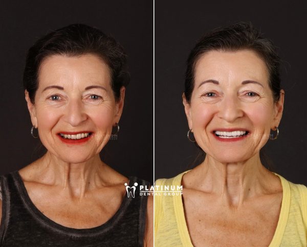 Porcelain veneers are seen as the top aesthetic solution