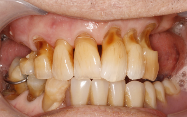 Tooth wear is the gradual erosion of enamel and dentin, unrelated to decay