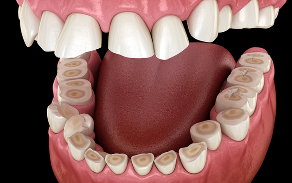Grinding or clenching teeth, often in sleep, puts excessive force on tooth surfaces