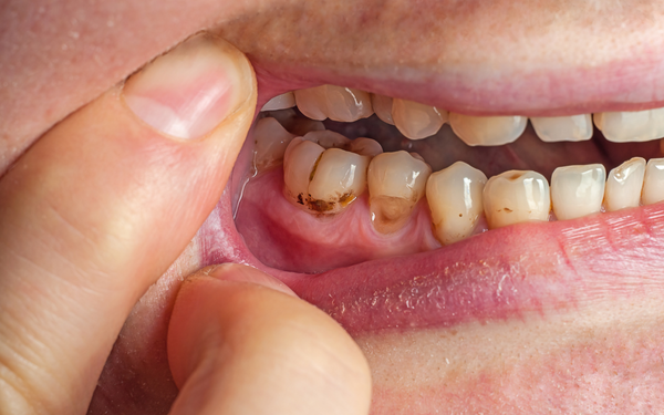When enamel wears down, yellow dentin shows through, making teeth appear discolored