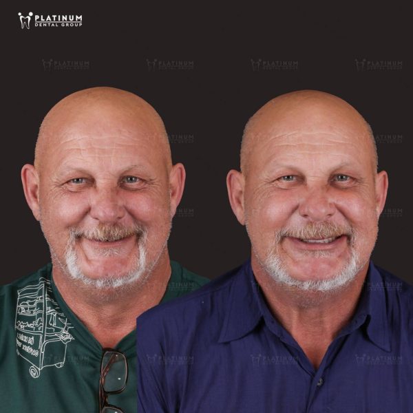 Types of dental implants pictures