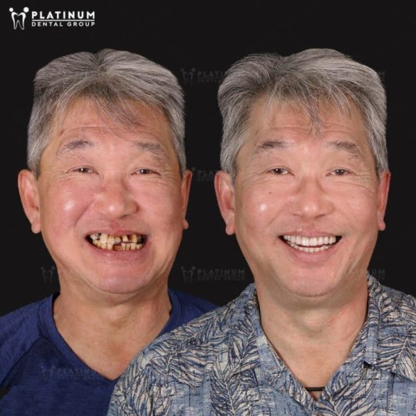 Types of dental implants PDF
