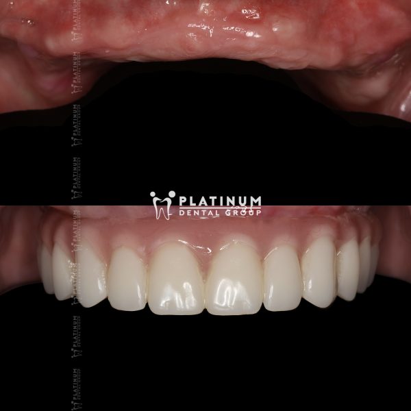 Common Types of Dental Implants: Facts and Tips for Your Smile 4 Common techniques for this solution are often known as All-on-4 or All-on-6