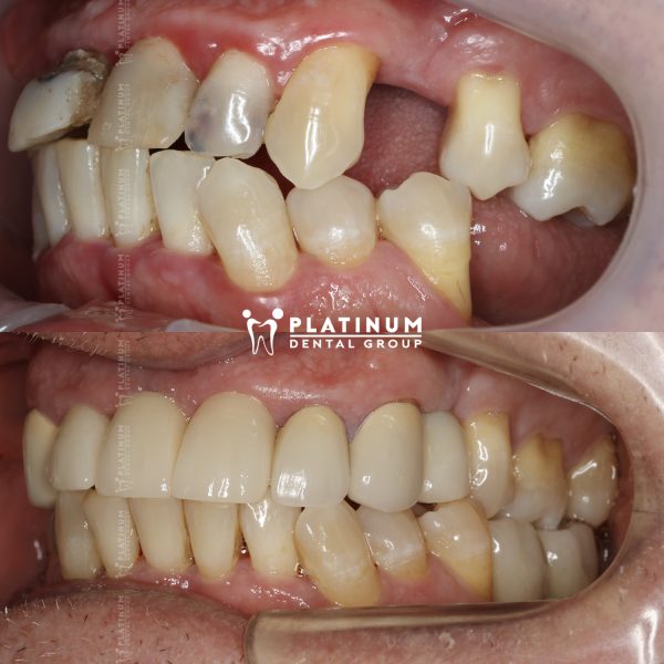 Common Types of Dental Implants: Facts and Tips for Your Smile 1 This is the ideal solution when you have lost a few teeth in different locations in your jaw.