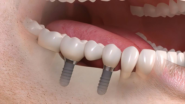 Common Types of Dental Implants: Facts and Tips for Your Smile 2 This approach provides reliable function while reducing the number of implants required.