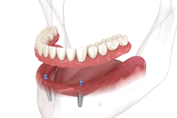 Common Types of Dental Implants: Facts and Tips for Your Smile 3 Implant overdentures are removable dentures.