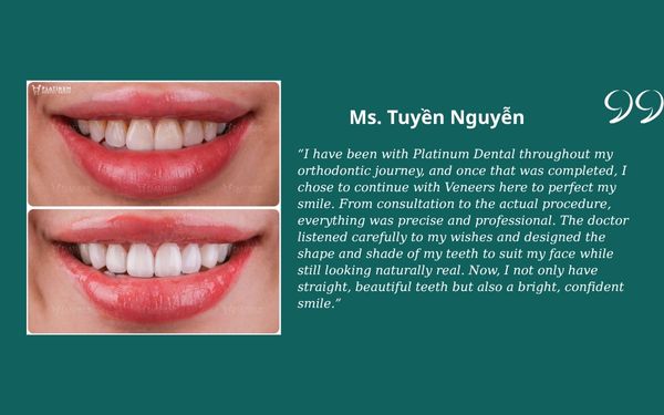 Veneers vs Crowns Tuyen Nguyen