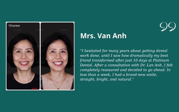 Veneers vs Crowns Mrs. Van Anh