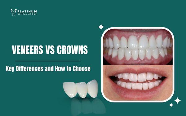 Veneers vs Crowns: Key Differences and How to Choose