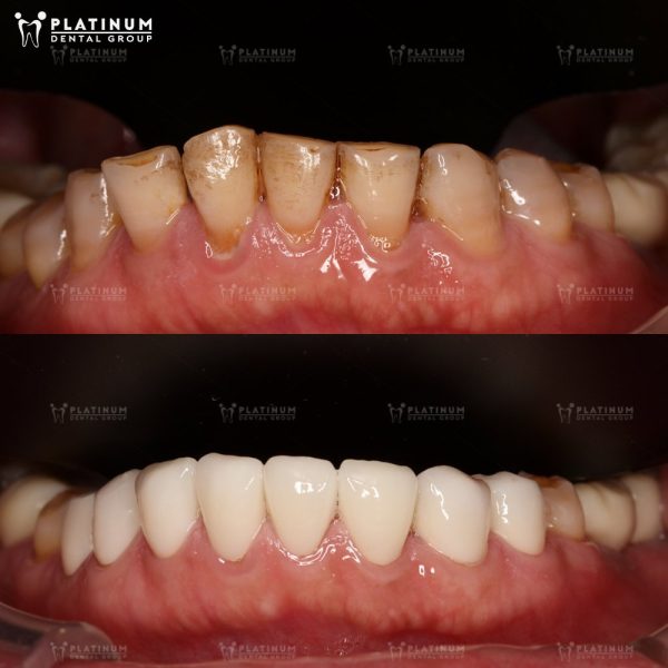 A crown fully covers the tooth, restoring its natural shape.