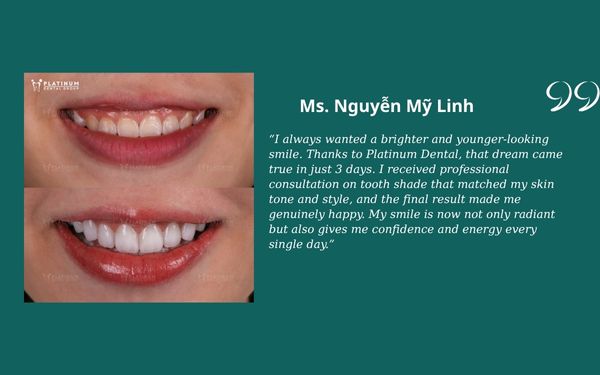 Veneers vs Crowns Nguyen My Linh