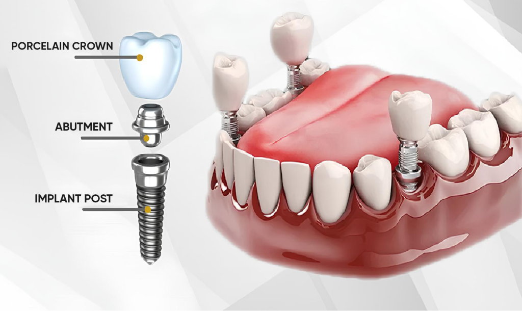 What is dental implant ?