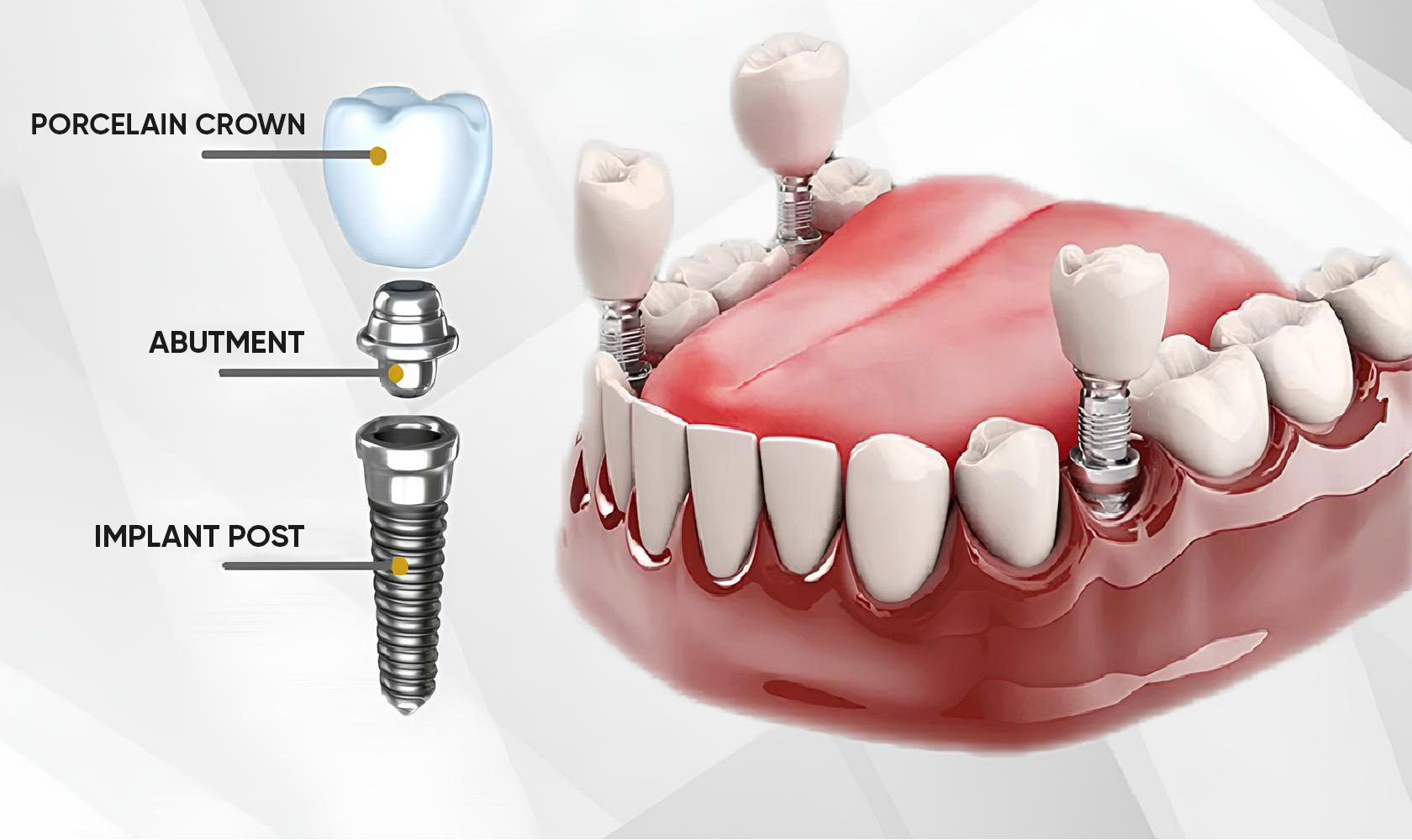 What is dental implant?