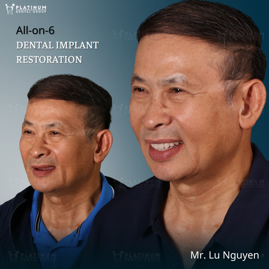 Mr - lu nguyen all on 6