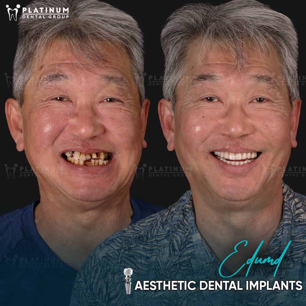 edumd aesthentic dental implant