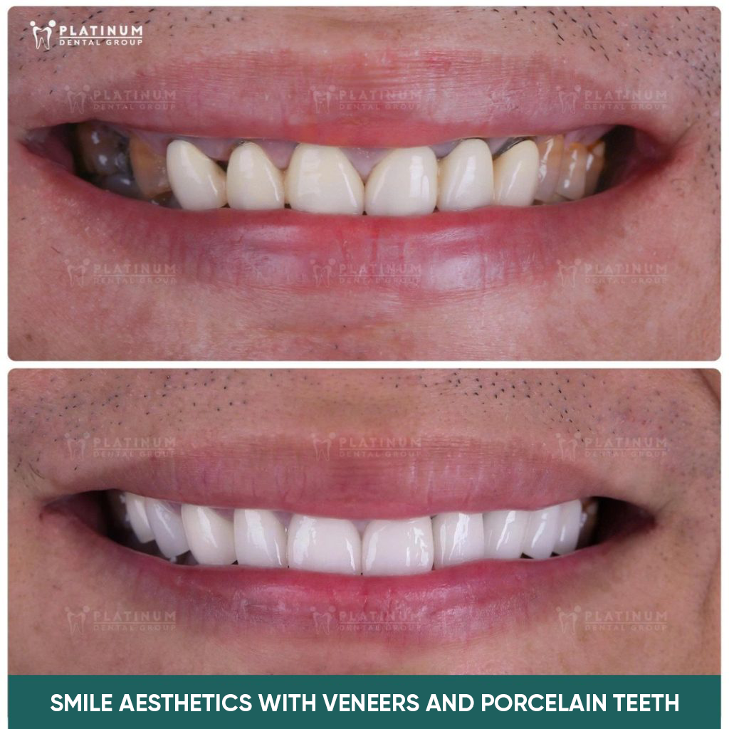 smile aesthetics with porcelain veneers