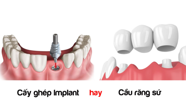 Nên chọn bắc cầu răng sứ hay trồng răng Implant?