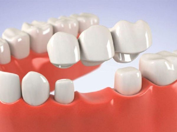 Bắc cầu răng sứ được sử dụng để thay thế một hoặc nhiều răng đã mất