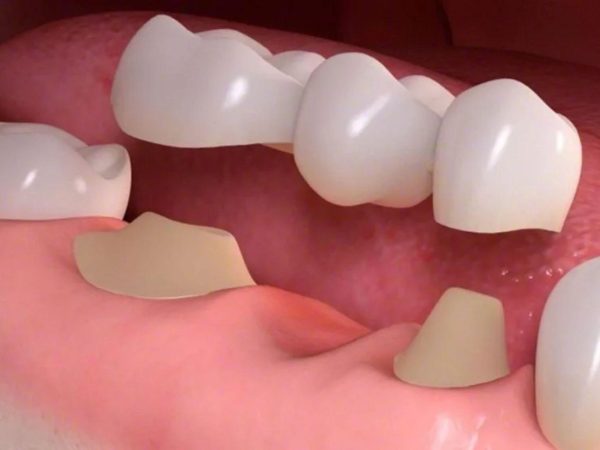 Bắc cầu răng sứ có tốt không?