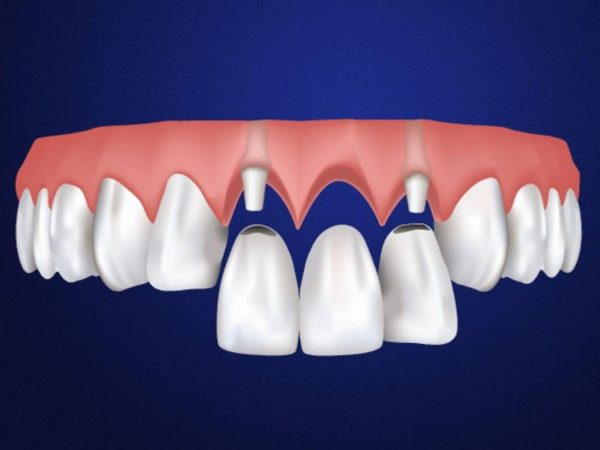 Bắc cầu răng sứ phù hợp với cô chú anh chị không muốn trải qua phẫu thuật cấy ghép