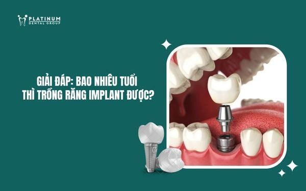bao nhiêu tuổi thì trồng răng implant được