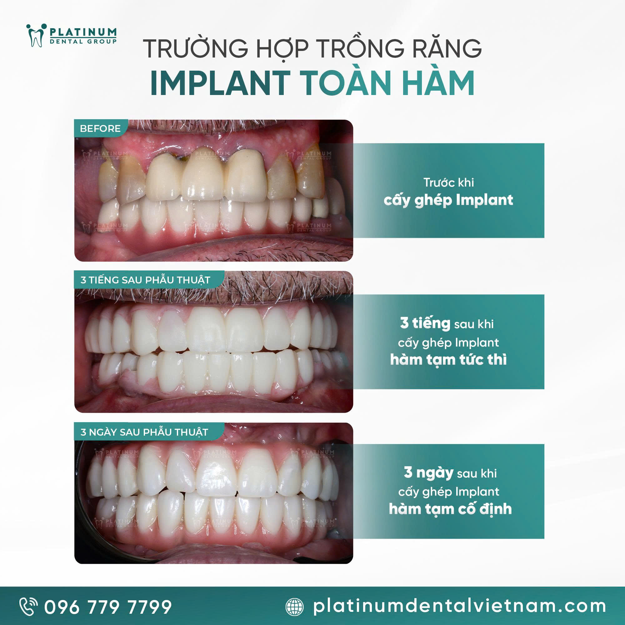 Minh họa trường hợp phục hình tạm tức thì cho bệnh nhân cấy ghép Implant toàn hàm tại Platinum Dental