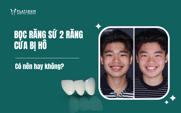 bọc răng sứ 2 răng cửa bị hô