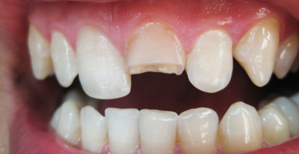 Răng cửa bị sứt mẻ, bạn nên bọc răng sứ để đảm bảo thẩm mỹ răng