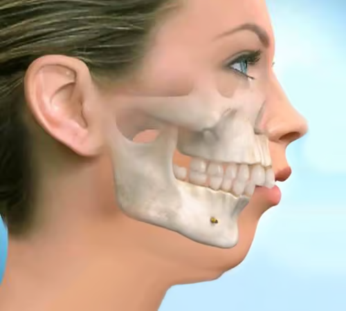 Răng cửa bị hô nhẹ thì có thể bọc răng sứ