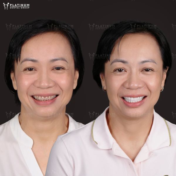 Platinum Dental Group ưu tiên sử dụng chất liệu sứ cao cấp cho khách hàng