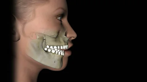 Bọc răng sứ không thể khắc phục được tình trạng răng nếu bị hô do cấu trúc xương hàm