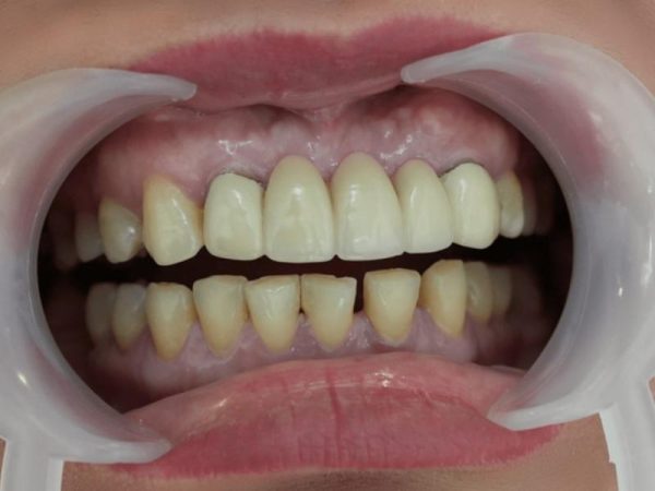 Có nên bọc răng sứ 500k không? 7+ rủi ro tiềm ẩn 2 Bọc răng sứ giá rẻ dễ gây hở cổ răng, tạo khe hở tích tụ thức ăn