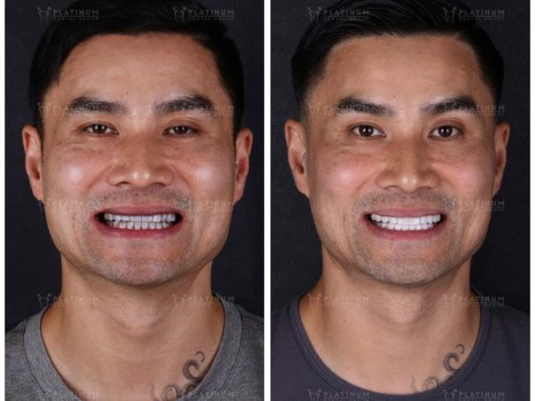 Bọc sứ răng cửa: Chi phí, quy trình chuẩn nha khoa 8 Trước - Sau bọc sứ răng tại Platinum Dental Group - Khách hàng lấy lại nụ cười tự tin, răng trắng đều và hài hòa tự nhiên