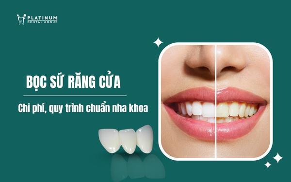 bọc sứ răng cửa