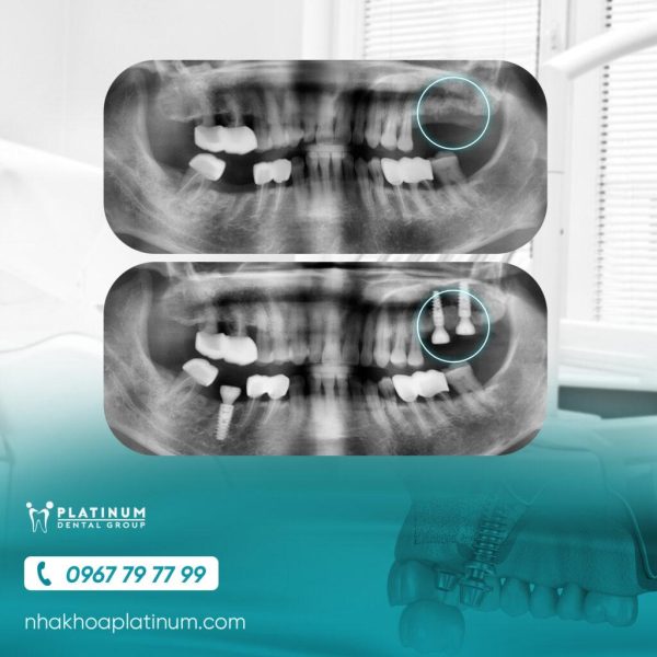 Chân răng Implant của Platinum Dental Group gồm trụ Implant + Abutment + răng sứ Cercon