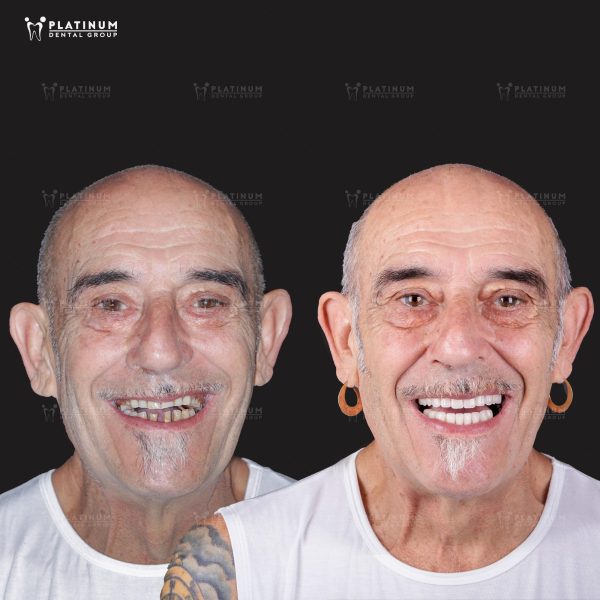 Mr. Ernesto chia sẻ rằng trải nghiệm nha khoa tại Platinum Dental Group không chỉ dễ dàng mà còn là tuyệt vời nhất so với tất cả những nơi anh từng đến trước đây