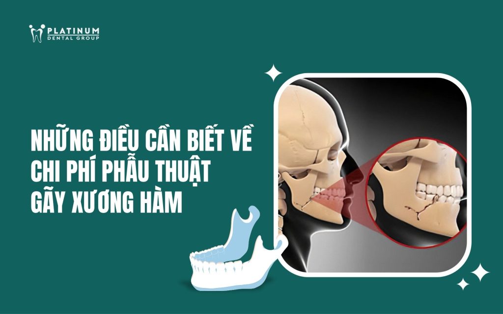 chi phí phẫu thuật gãy xương hàm